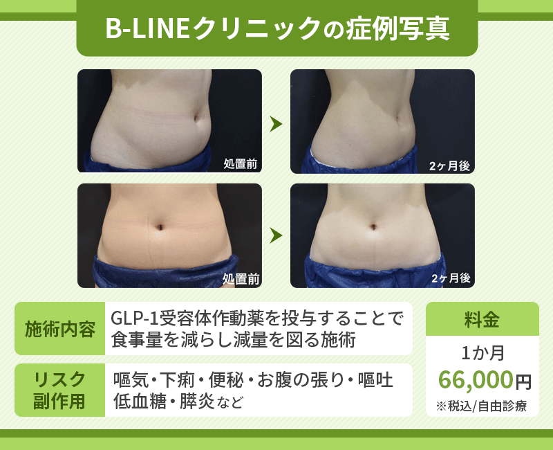 GLP-1ダイエット 症例