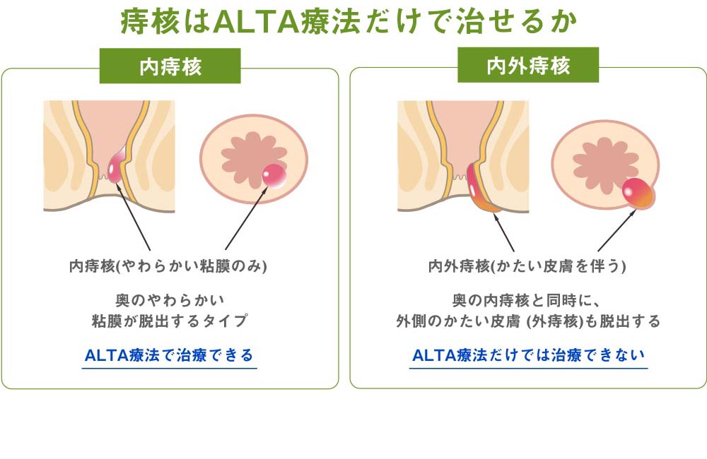 痔について｜むらた日帰り外科手術クリニック