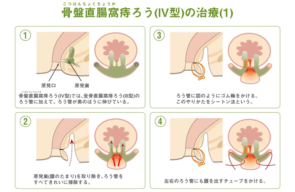 痔について むらた日帰り外科手術クリニック